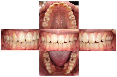 Case report: Treatment of persistent atypical odontalgia with attention deficit hyperactivity disorder and autism spectrum disorder with risperidone and atomoxetine
